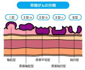 転移性胃がんの症状は何ですか?